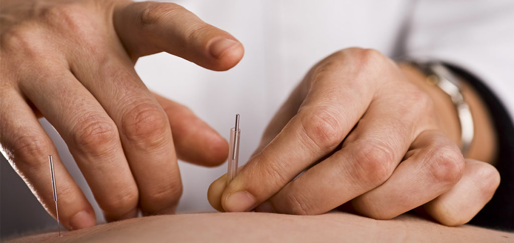 physiotherapist performing dry needling
